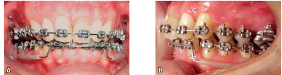 FIGURA 7 - Arco de intrusão para incisivos, tipo Burstone, confeccionado com liga de beta-titânio e apoiado em arco base: A) vista frontal e B) vista lateral.