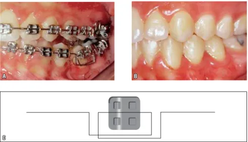 FIGURA 5 - A) Continuação do alinhamento e nivelamento do segundo pré-molar (Fig. 4A) com fio de aço 0,016” 