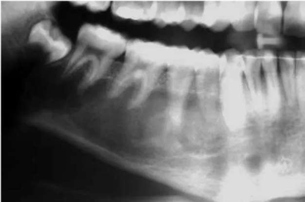FIGURA 2 - Caso 1: radiografia panorâmica inicial, onde se observa lesão radio- radio-lúcida próxima às raízes dos dentes 45 e 46.