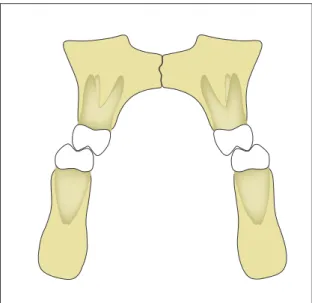 FIGURA 9 - Coincidência das linhas médias dentárias e mordida cruzada es- es-quelética posterior bilateral quando em MIH.