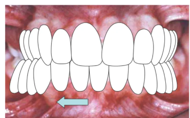 FIGURA 13 - Em MIH, há desvio da linha média dentária inferior e mordida cru- cru-zada posterior unilateral.