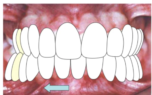 FIGURA 20 - Desvio mandibular MIH.