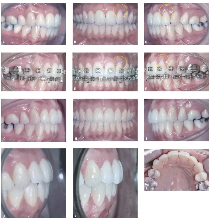 FIGURA 10 - Caso 2: paciente encaminhada pelo dentista clínico para retratamento, por apresentar falta de equilíbrio oclusal