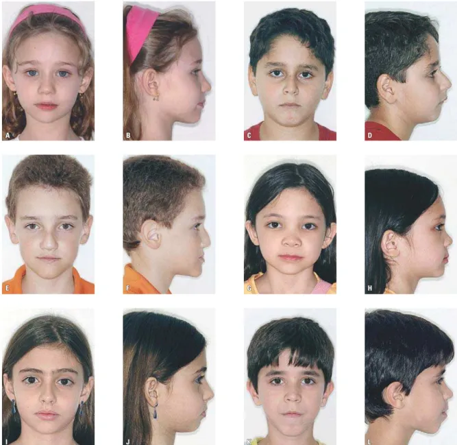 FIGURA 7 - Características morfológicas dos padrões e tipos faciais na dentadura decídua: A, B) Padrão I; C, D) Padrão II; E, F) Padrão III; G, H) tipo braquifacial; 