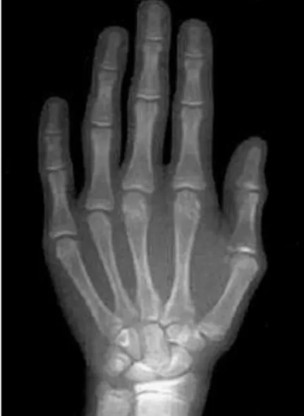 FIGURA 1 - Radiografia da mão e punho de um paciente do gênero feminino  com 10 anos de idade: ossos carpais, metacarpianos e falanges.