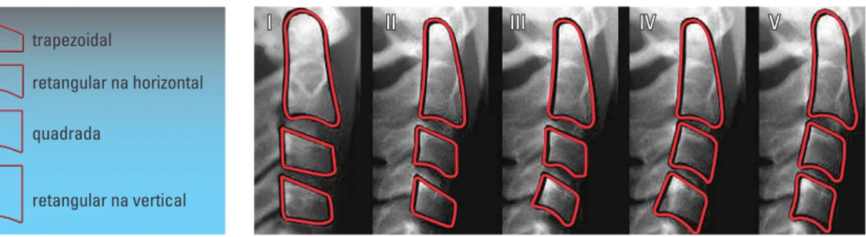FIGURA 2 - Esquema das formas das vértebras cervi- cervi-cais e as quatro alterações morfológicas.