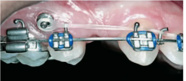 FIGURA 19 - A) Detalhe aproximado da cabeça do mini-implante, dimensionada para encaixe de molas de nitinol