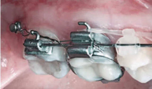 FIGURA  22  -  Ancoragem  indireta  com  mini-implante  instalado  na  tuberosi- tuberosi-dade maxilar.