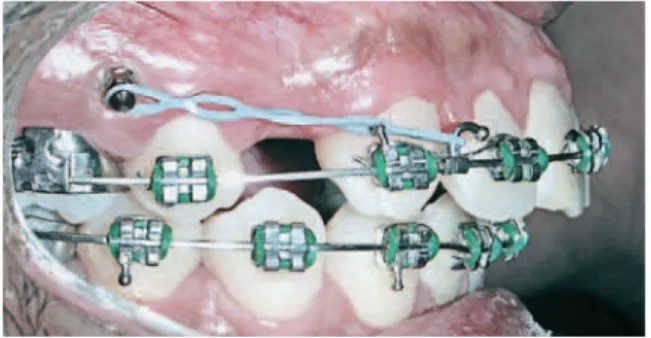 FIGURA 2 - Retração anterior com ancoragem direta.