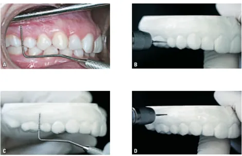 FIGURA 1 - A) Eleição do local para instalação dos mini-implantes, no limite entre as mucosas livre e ceratinizada