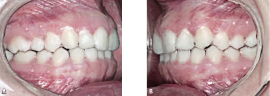FIGURA 2 - Moldeiras de acetato posicionadas na boca, com os pontos selecionados e preenchidos com guta-percha: ponto de contato entre as coroas dentárias e  local eleito para inserção de mini-implantes