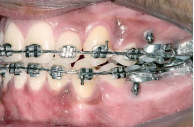 FIGURA 1 - Ilustração da localização dos mini-implantes, na maxila e mandí- mandí-bula,  em  um  paciente  participante  da  pesquisa,  após  a  retração  dos  dentes  anteriores.