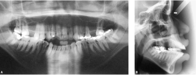 FIGURA 2 -  A)  Radiografias panorâmica e  B)  telerradiografia lateral pré-tratamento