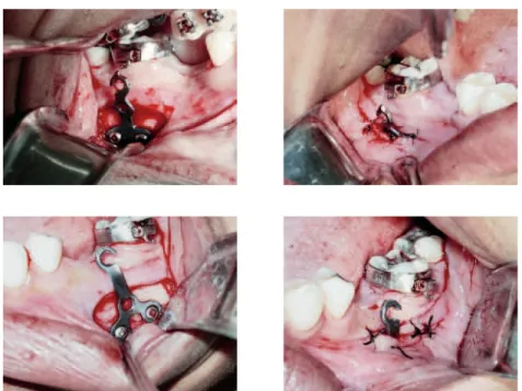 FIGURA 5 - Procedimentos cirúrgicos para instalação das miniplacas na mandíbula.