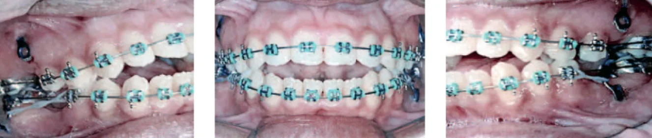 FIGURA 10 - Fase intermediária do tratamento, com retração superior provisoriamente estacionada e retração ântero-inferior acelerada, somada à mesialização dos  molares inferiores.