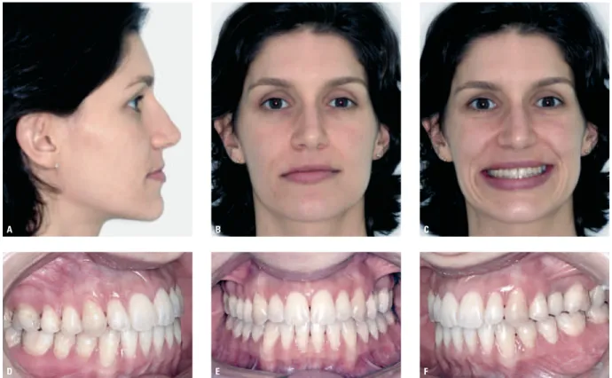 FIGURA 14 - Fotografias finais com a correta oclusão estabelecida: A, B, C) imagens extrabucais e D, E, F) imagens intrabucais.