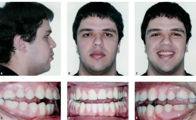FIGURA 5 - Fotos iniciais apresentando mordida aberta assimétrica: A, B, C) imagens extrabucais e D, E, F) imagens intrabucais.
