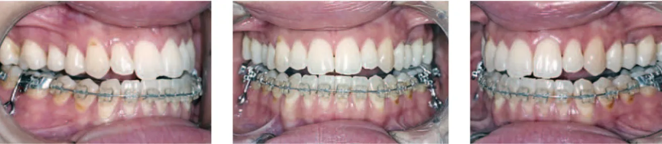 FIGURA 13 - Evolução do tratamento com a ativação do aparelho utilizando elásticos em corrente apoiados nas miniplacas para intrusão dos molares inferiores.