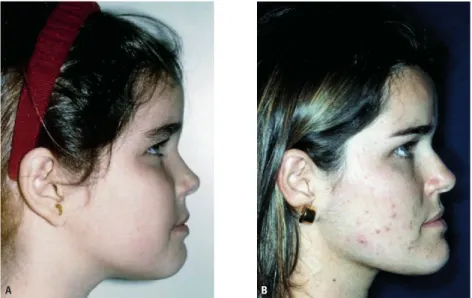 FIGURA 1 - Fotografias extrabucais de paciente sem tratamento, em idade: A) pré-puberal; B) pós-puberal.