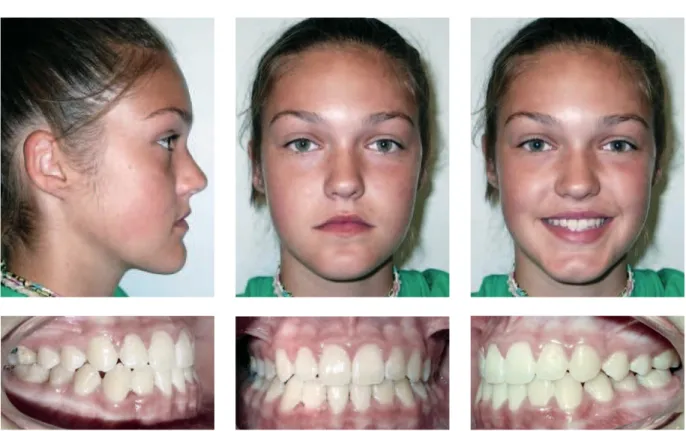 FIGURA 8 - Fotografias extrabucais e intrabucais pós-tratamento, demonstrando harmonia dentária e facial.