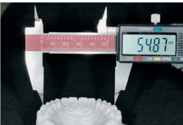 FIGURA 1 - Medida da largura dos dentes com paquímetro digital. FIGURA 2 - Medida da distância intermolares no modelo de gesso.