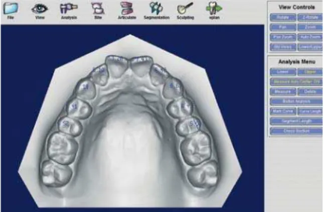FIGURA 3 - Medidas digitais da largura dos dentes - Programa eModel.
