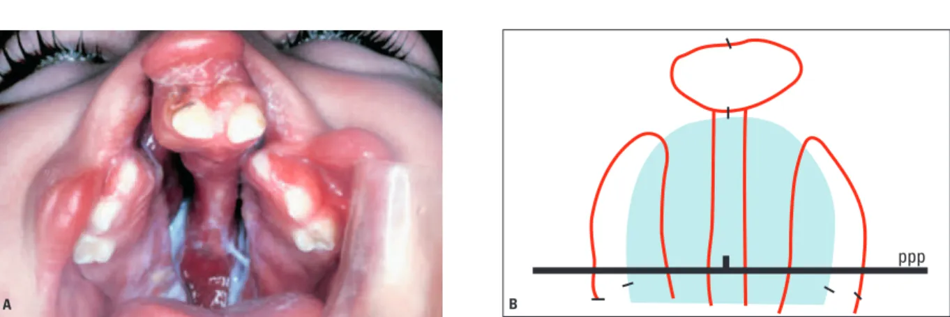 FIGURA 1 - A) Fissura bilateral completa de lábio e palato: segmentação da maxila em três partes, preservando a morfologia embrionária