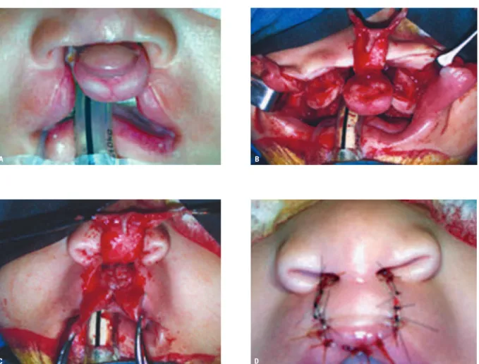 FIGURA 3 - O enxerto ósseo secundário fecha o ciclo de cirurgias que reconstroem a fissura de lábio e palato
