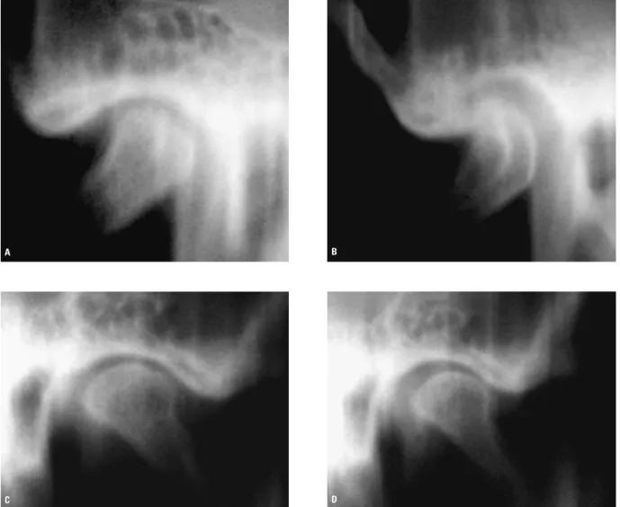 FIGURA 4 - A) Radiografia transcraniana do côndilo direito com a boca fechada. B) Radiografia transcraniana do côndilo direito com a boca aberta