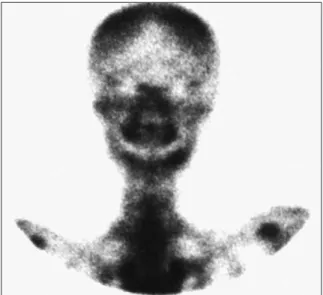 FIGURA 9 - Tomografia computadorizada corte coronal, após 1 ano. FIGURA 10 - Cintilografia óssea