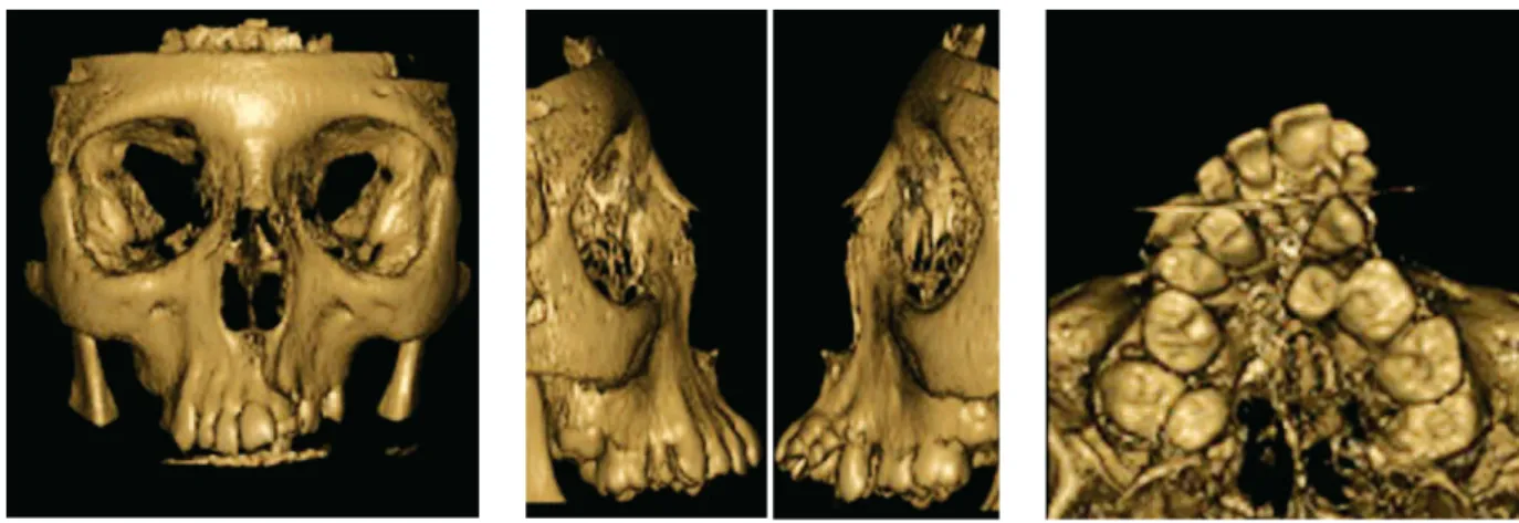 FIGURA 16 - Reconstrução tridimensional (3D) em tomografia computadorizada de feixe cônico.