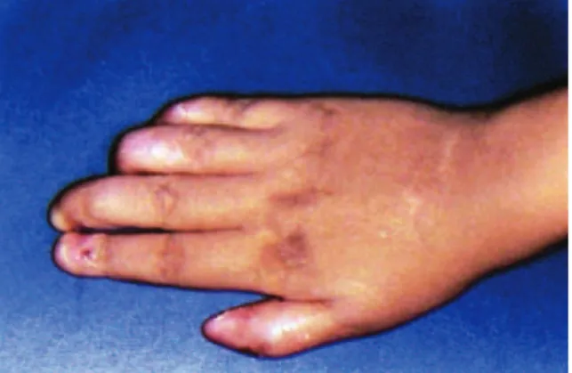 FIGURA 3 - Região dorsal da mão direita, ausência de unhas, desenvolvimen- desenvolvimen-to alterado por resistência elástica do epitélio.