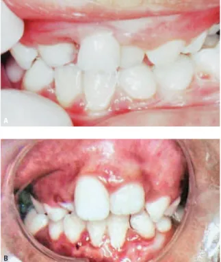 FIGURA 6 - Alteração do desenvolvimento normal da oclusão. A) Lesão ul- ul-cerada na papila gengival entre os elementos 74 e 75