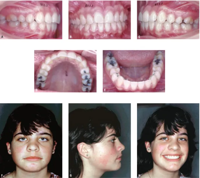 FIGURA 7 – Face e oclusão aos 15 anos de idade, 3 anos após a remoção dos aparelhos, evidenciaram que a paciente não mostrava mais vestígios faciais daquilo  que, no exame inicial, poderia ter sido considerado uma face longa moderada