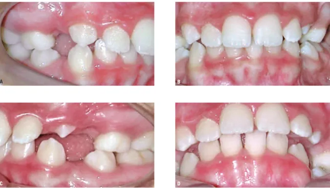 FIGURA 9 – Fotografias intrabucais depois de realizadas as exodontias dos primeiros pré-molares superiores e inferiores, com a intenção de diminuição do volume  bucal e favorecimento da erupção dos caninos permanentes em seu “locu”.