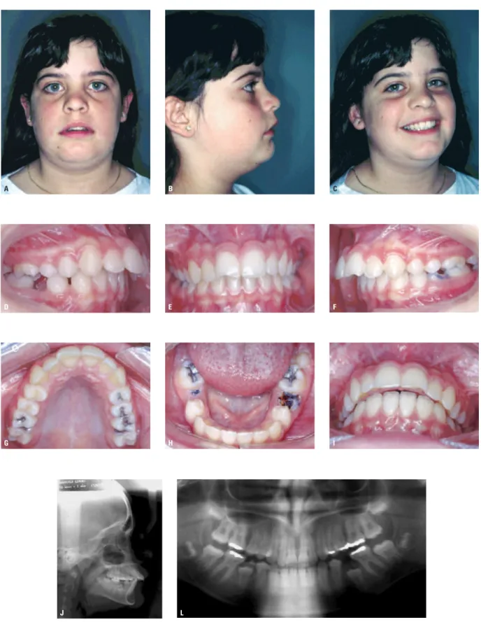 FIGURA 4 – Face (A-C), oclusão (D-I) e radiografias iniciais (J, L) de uma paciente, aos dez anos de idade, representando uma  ocorrência clínica que poderia ser classificada como face longa moderada