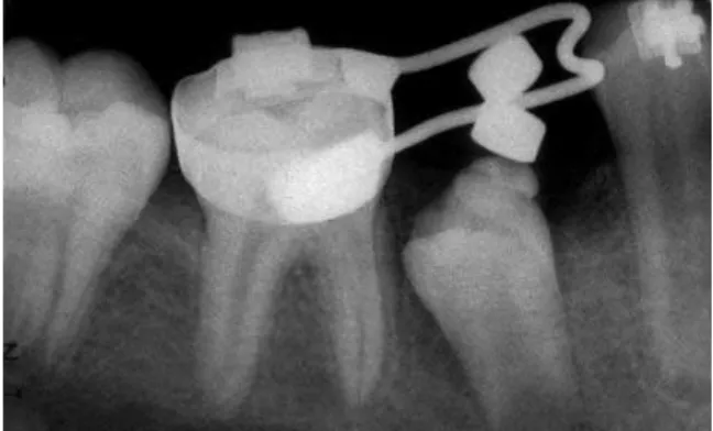 FIGURA 6 – Verticalização e extrusão parcial do segundo pré-molar inferior  direito.