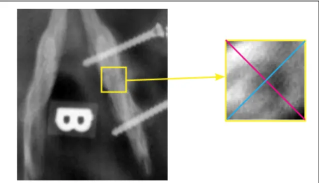 FIGURA 2 -  Imagem radiográfica selecionada e  as linhas para medição da  densidade óssea definidas.