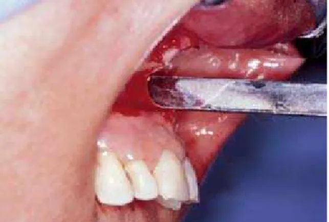 FIGURA 7 - Cinzel posicionado na região de pilar canino. FIGURA 8 - Osteotomia na região da sutura inter-maxilar com cinzéis.