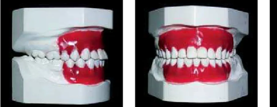 FIGURA 4 - Fotografias intrabucais mostrando o aparelho montado: lateral direita, frente e lateral esquerda.