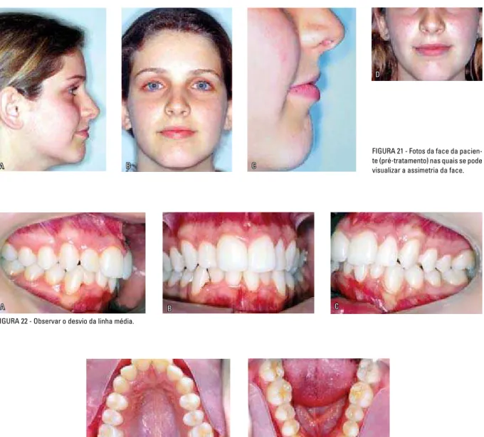 FIGURA 21 - Fotos da face da pacien- pacien-te (pré-tratamento) nas quais se pode  visualizar a assimetria da face.
