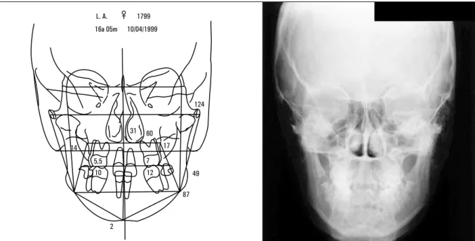 FIGURA 25 - Telerradiografia de norma frontal e cefalograma de Ricketts.