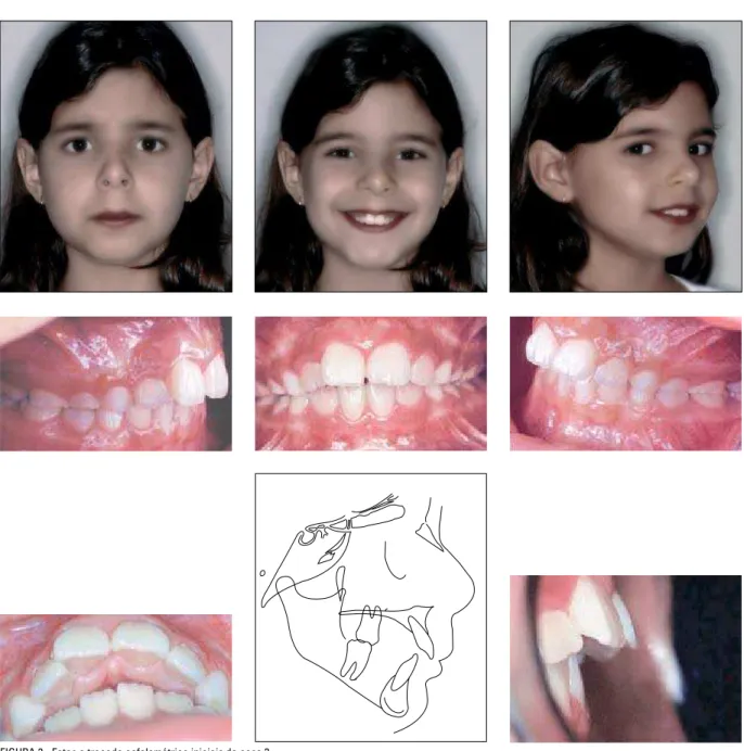 FIGURA 3 - Fotos e traçado cefalométrico iniciais do caso 3.