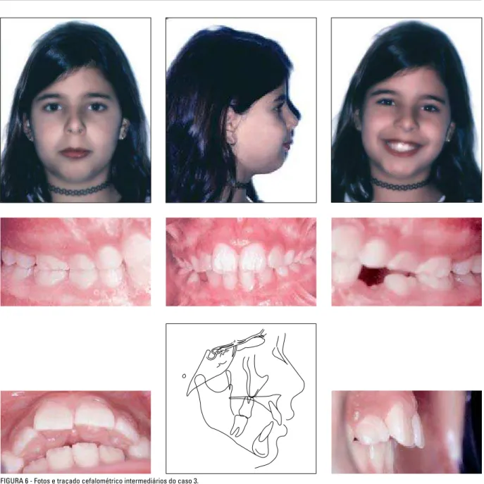 FIGURA 6 - Fotos e traçado cefalométrico intermediários do caso 3.