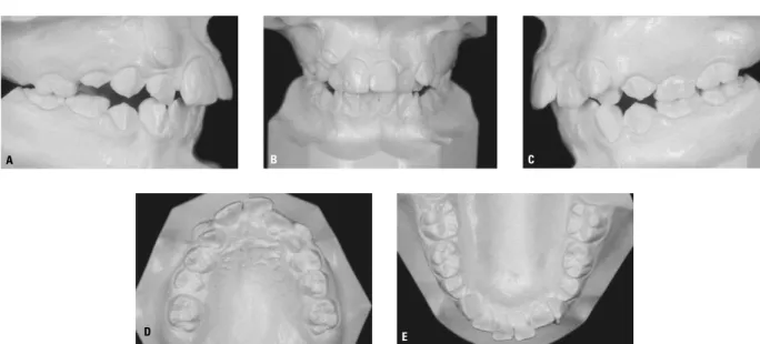 FIGURA 2 - Diagnóstico do padrão dentário pelos modelos de gesso. Má oclusão Classe II, divisão 1 ( A, B, C ), com apinhamento anterior superior e inferior ( D, E )