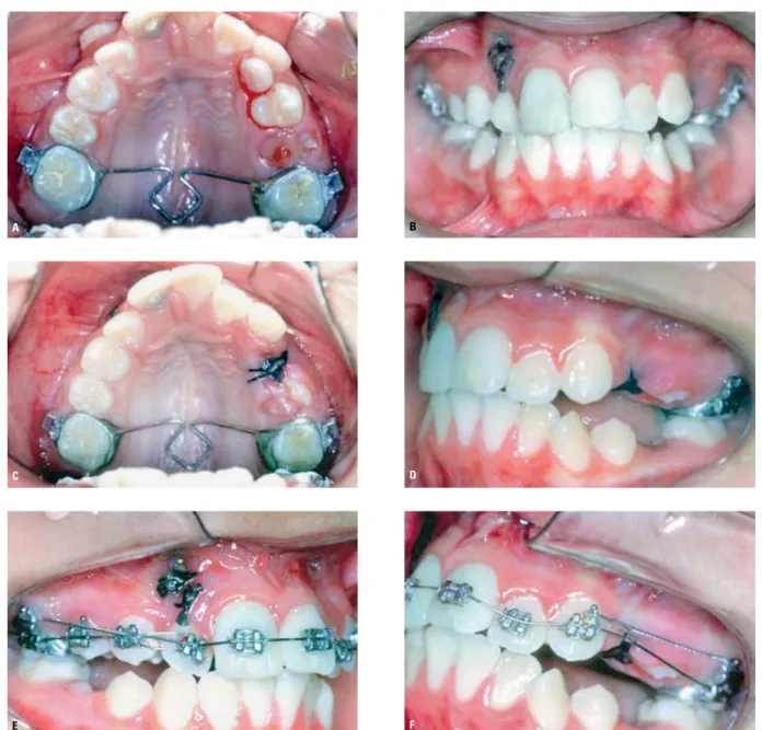 FIGURA 4 - Mecanoterapia no arco dentário superior. Instalação da ancoragem superior (A), extração dos dentes 13 e 24 (B, C, D) e mecânica subseqüente de  nivelamento associado à rotação do dente 12 e retração inicial do dente 23 ( E, F ).