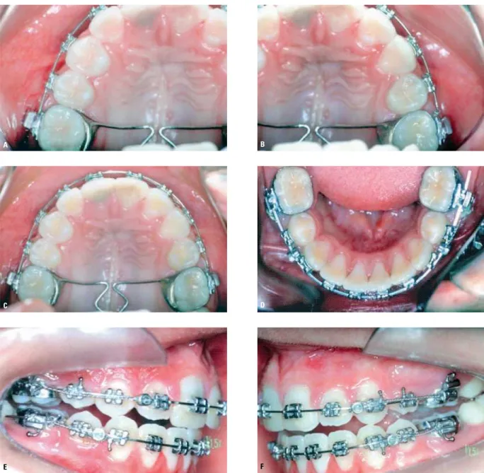 FIGURA 5 - Estágio final da mecanoterapia, após o fechamento dos espaços das extrações superiores (A, B, C) e inferiores (D)