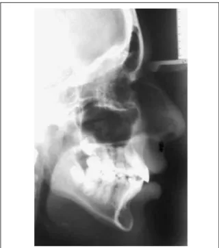 FIGURA 8 - A telerradiografia final expõe as características inerentes à face  longa.