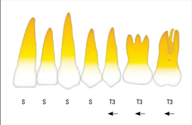 FIGURA 26 - Braquetes standard para os anteriores até o primeiro pré-molar,  e acessórios de translação média no segundo pré e molares (T2).