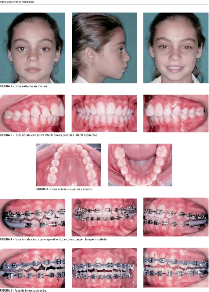 FIGURA 2 - Fotos intrabucais (vista lateral direita, frontal e lateral esquerda).